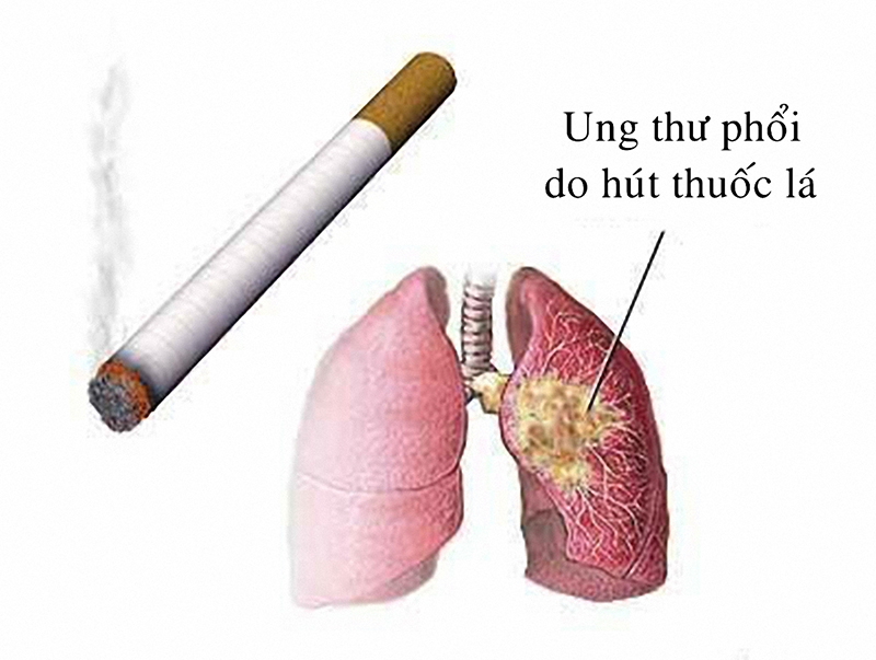 Hút thuốc lá là nguyên nhân chính gây ung thư phổi.